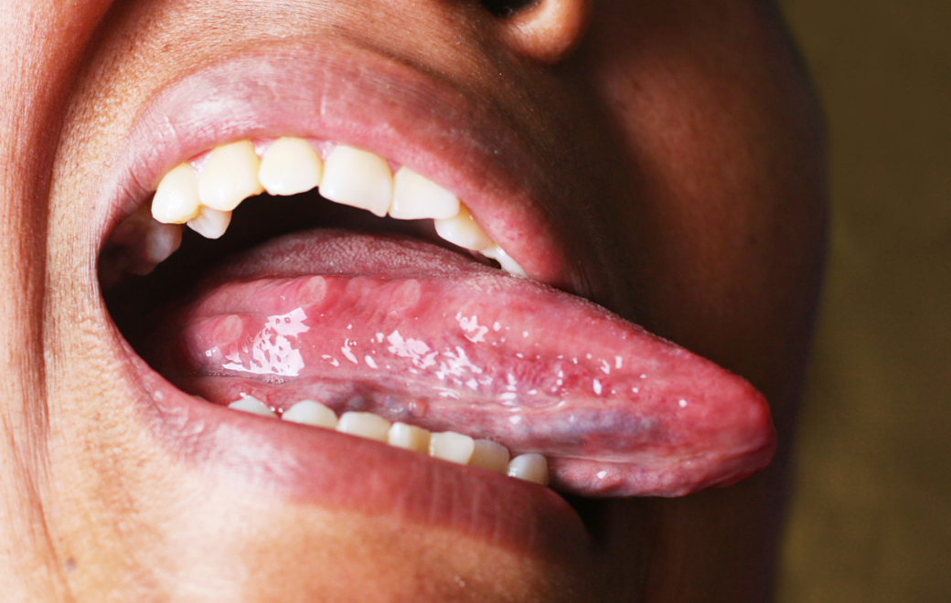 Prévenir les mucites : quels conseils au comptoir ?