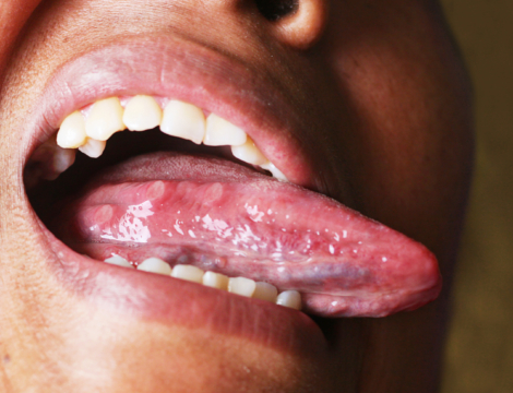 Prévenir les mucites : quels conseils au comptoir ?