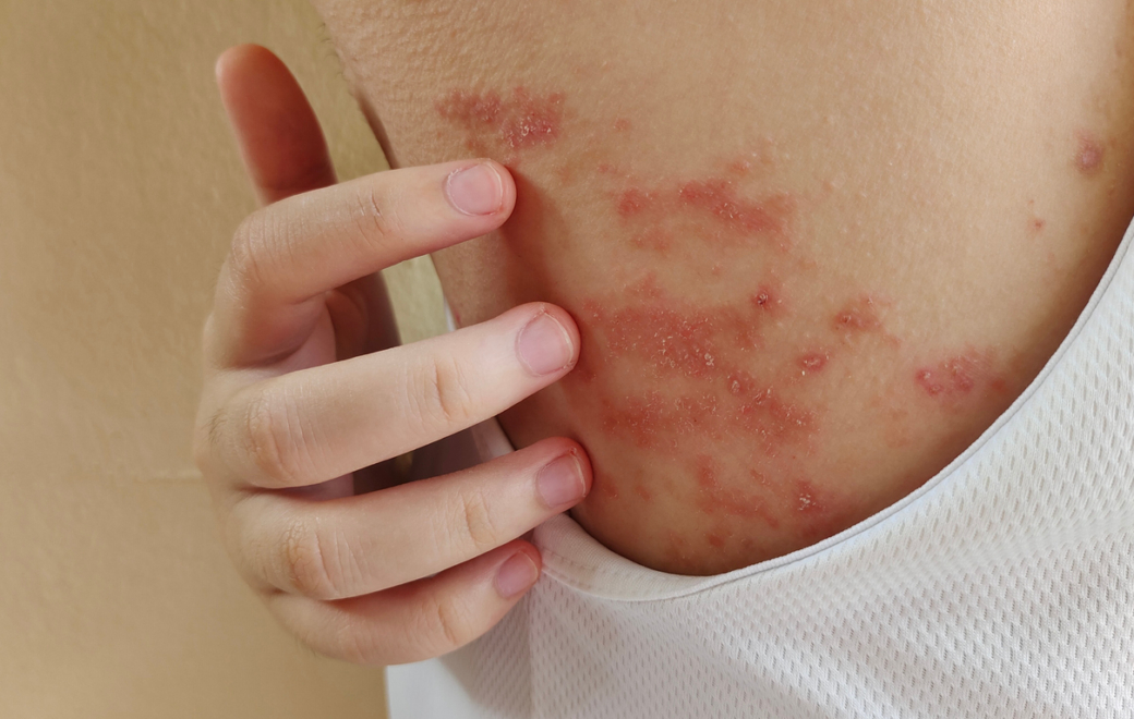 Produits de contraste iodés : prévenir les réactions d’hypersensibilité retardée