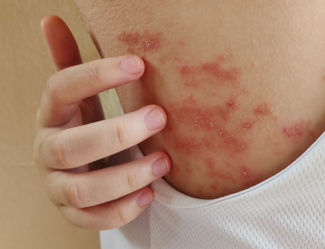 Produits de contraste iodés : prévenir les réactions d’hypersensibilité retardée