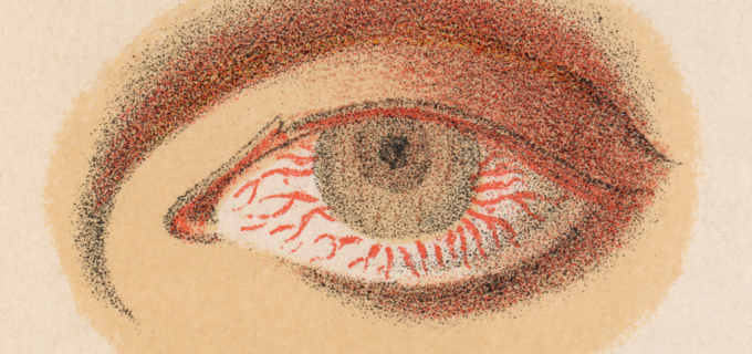 2/8 – Conjonctivites infectieuses : limiter la transmission et le risque de surinfection