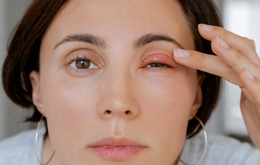 5/8 – Pathologies des paupières : savoir distinguer les différentes affections