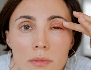 5/8 – Pathologies des paupières : savoir distinguer les différentes affections
