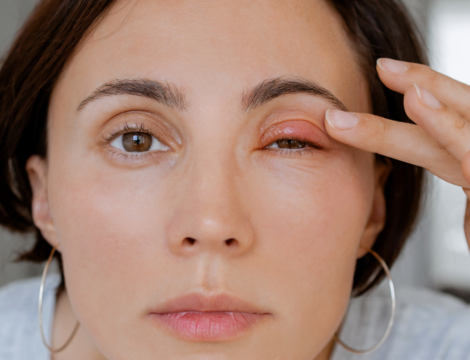 5/8 – Pathologies des paupières : savoir distinguer les différentes affections