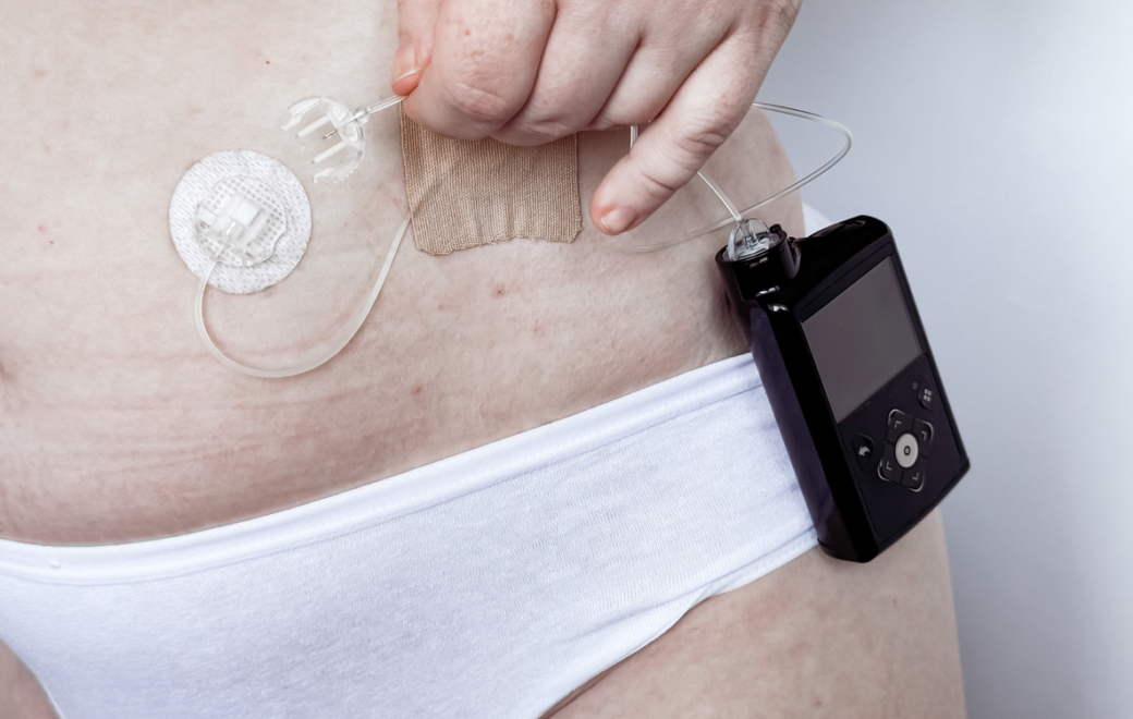 Novo Nordisk : tensions d’approvisionnement sur les cartouches d’insuline compatibles YpsoPump