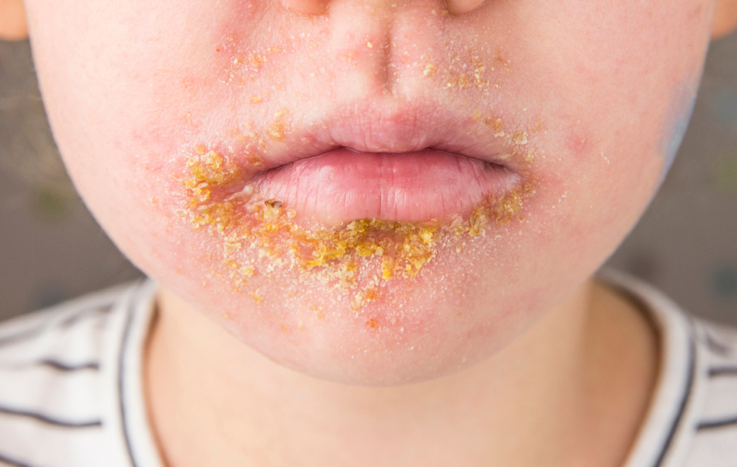 Qu’est-ce que l’impétigo ?