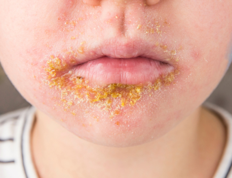 Qu’est-ce que l’impétigo ?