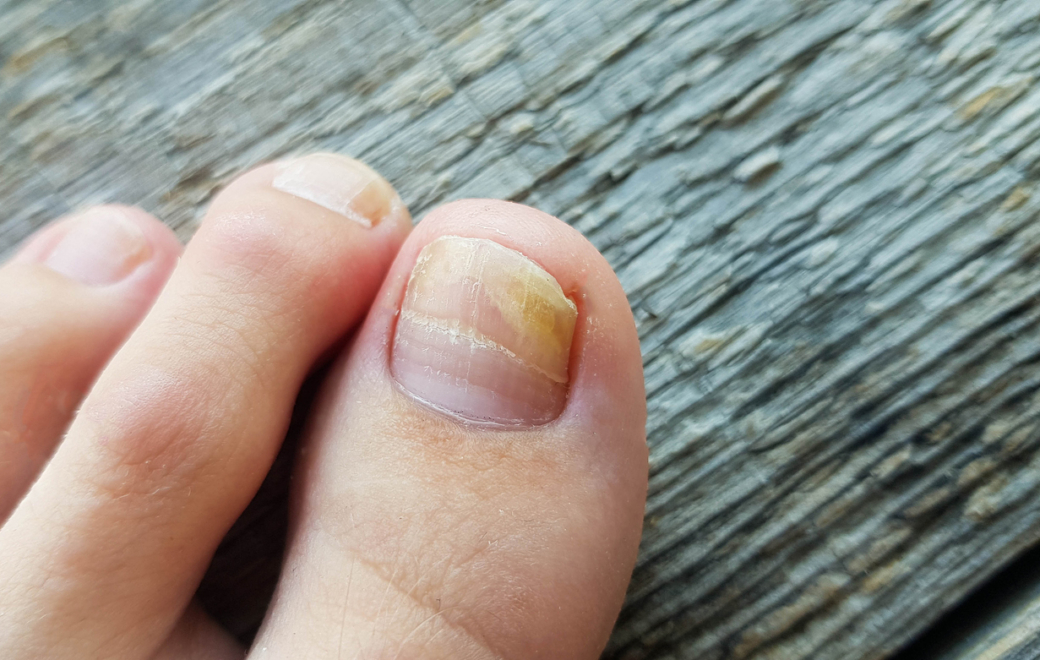 Onychomycoses : comprendre, traiter et prévenir les récidives