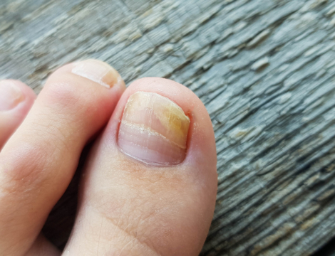 Onychomycoses : comprendre, traiter et prévenir les récidives