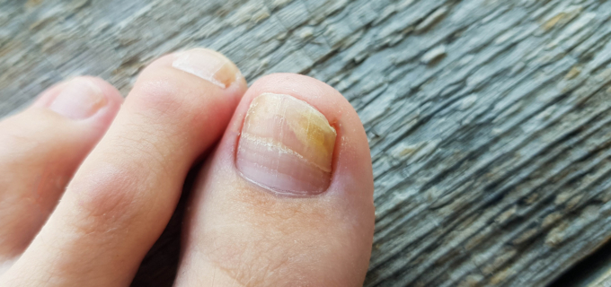 Onychomycoses : comprendre, traiter et prévenir les récidives