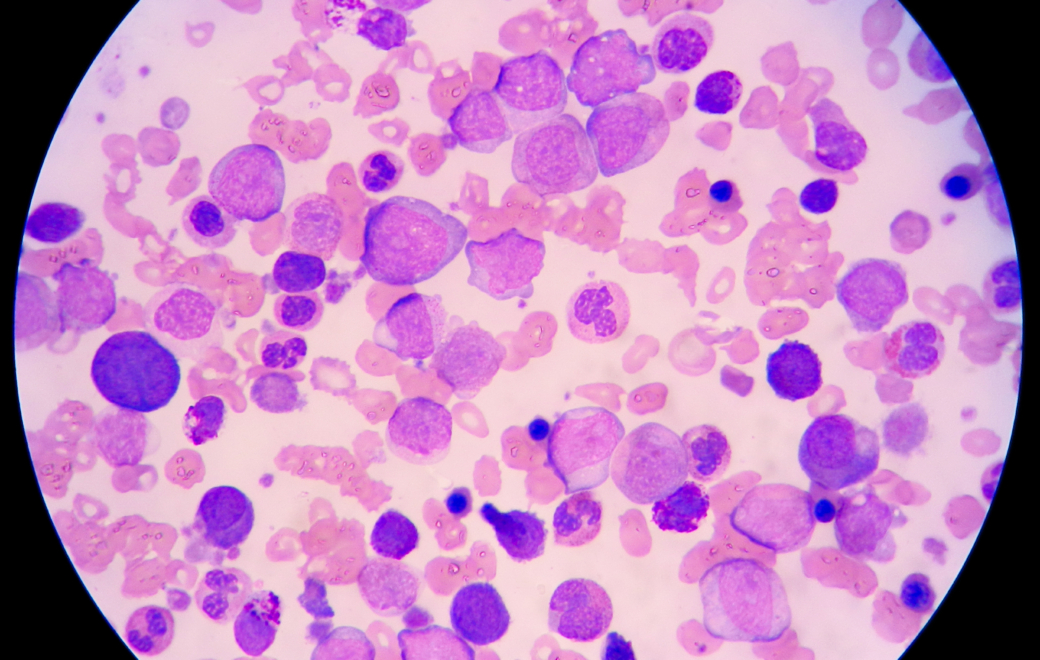 Tout savoir sur la leucémie myéloïde chronique