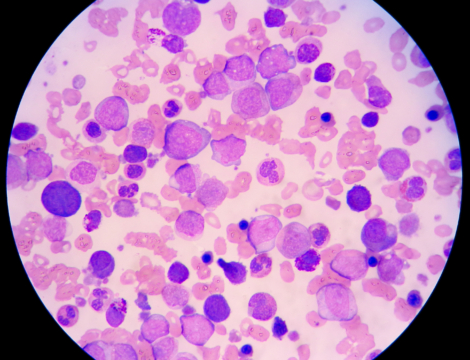 Tout savoir sur la leucémie myéloïde chronique