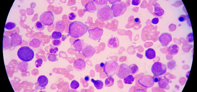 Tout savoir sur la leucémie myéloïde chronique