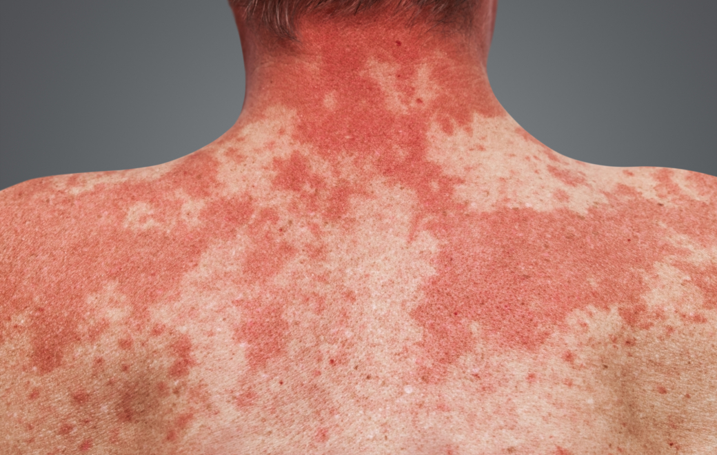 Qu’est-ce que le syndrome de la peau rouge ?