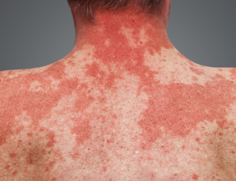 Qu’est-ce que le syndrome de la peau rouge ?