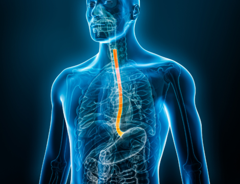 1/5 – Pathologie : le reflux gastro-œsophagien en 5 questions