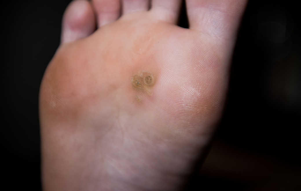Verrues plantaires : prise en charge à l’officine