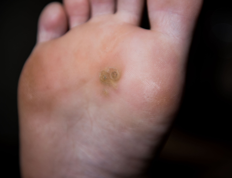 Verrues plantaires : prise en charge à l’officine