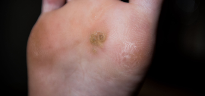 Verrues plantaires : prise en charge à l’officine