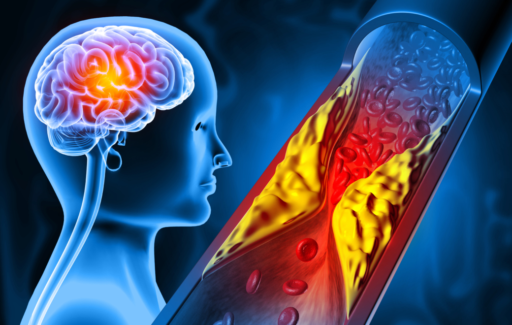 Hypercholestérolémie : quel accompagnement au comptoir ?