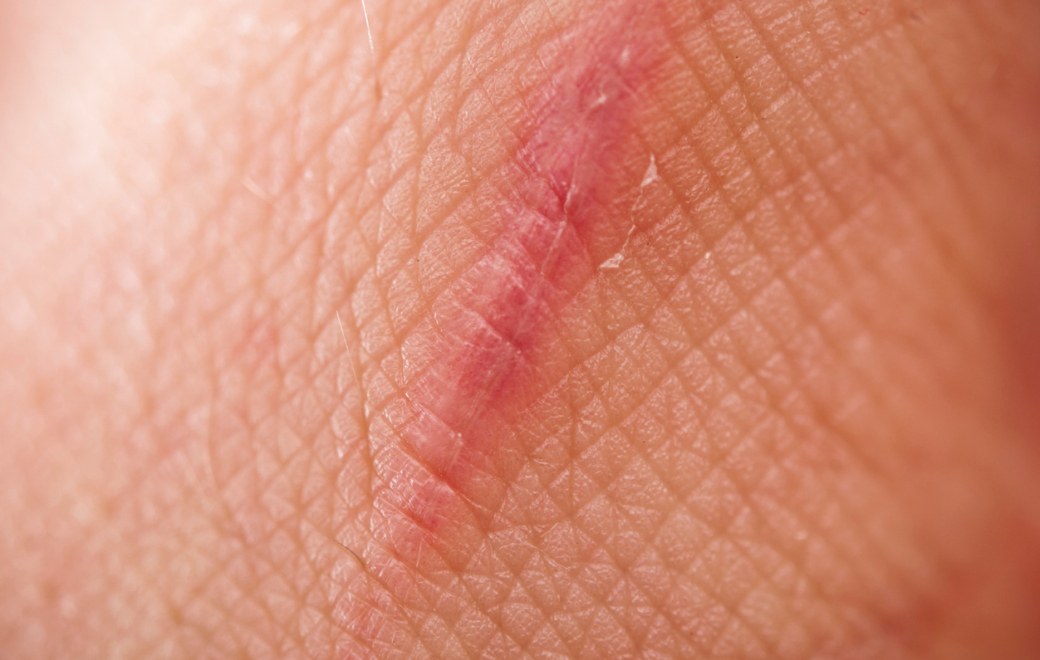 Les cicatrices de l&rsquo;affaire URGO