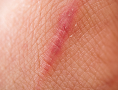 Les cicatrices de l&rsquo;affaire URGO