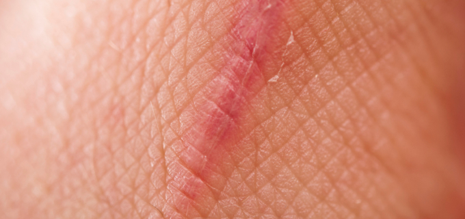 Les cicatrices de l&rsquo;affaire URGO