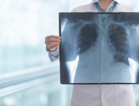 Une nouvelle impulsion pour le dépistage du cancer du poumon