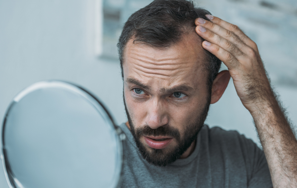 Comment accompagner la dispensation des traitements de l’alopécie androgénétique ?