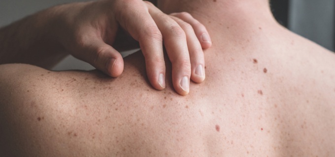 Prévention : le dépistage des cancers de la peau